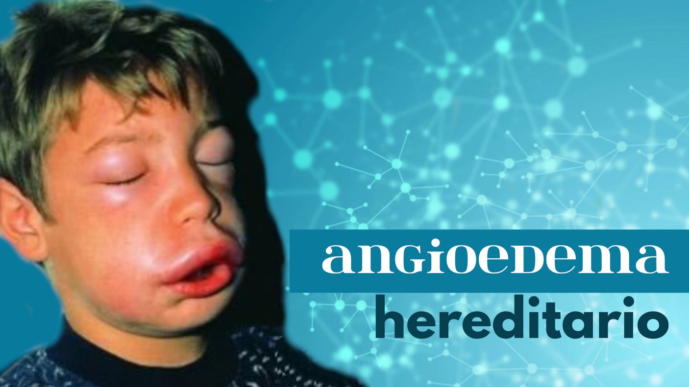 angioedema hereditario
